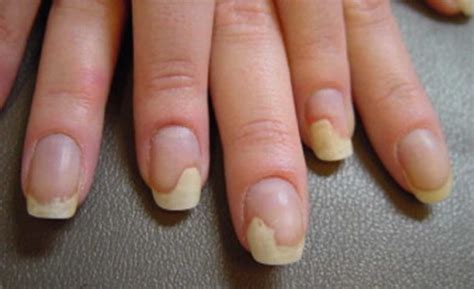 Nail Dystrophy Definition Causes And Treatment