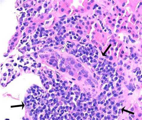 Renal Tubular Acidosis As The Initial Presentation Of Sjögrens