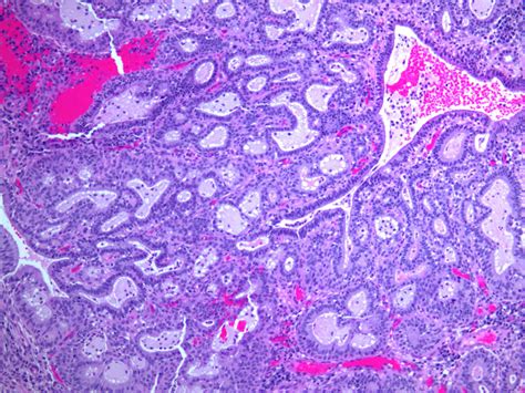 Pathology Outlines Microglandular Hyperplasia