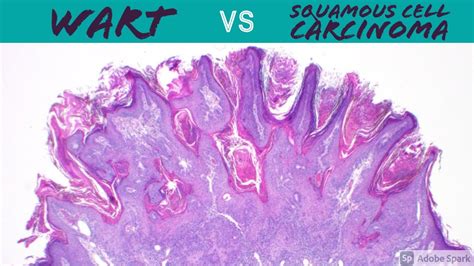 Wart Vs Squamous Cell Carcinoma Dermpath Pathology Dermatology Verruca