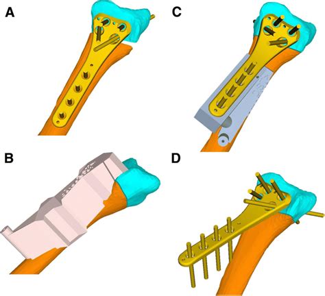 A Planned Opening Wedge Osteotomy With Shaft Orange And Distal