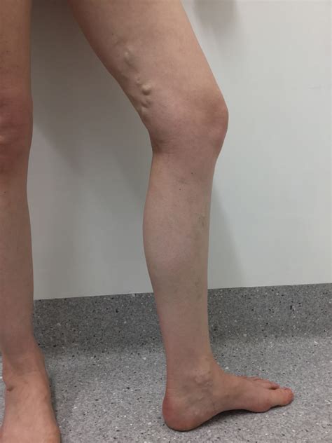Varicose Vein Removal Glue Laser Ultrasound — The Leg Vein Doctor