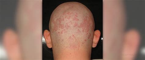Seborrheic Dermatitis Symptoms Skin Hair Problems Articles Body Health Conditions Center