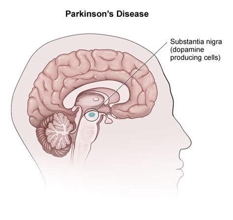 Parkinsons Disease Causes Symptoms Treatment Pictures Stages