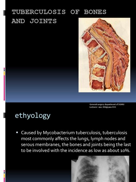 Tuberculosis Of Bones And Joints Pdf Tuberculosis Bone