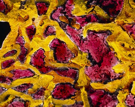 Coloured Sem Of Bone Marrow In Spongy Bone Stock Image P2340025