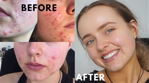 How I Cleared My Acne After Years Of Trying Skin Care Routine