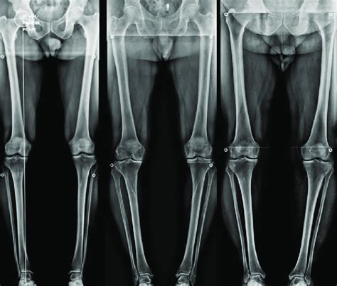 Preoperative Long Leg Alignment And Sample X Rays Download Scientific