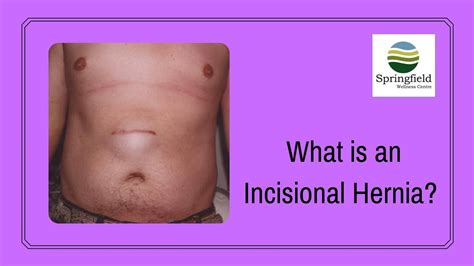 What Is An Incisional Hernia By Dr Maran A Hernia Surgeon In Chennai
