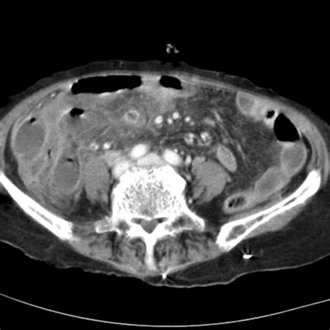 initial abdomen ct for an 83 yr old female abscess formation caused by download scientific