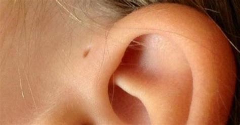 One In 100 People Have This Tiny Hole Above Their Ear This Is Why