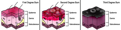 1100 x 738 jpeg 41 кб. Essential Facts about different types of burns and how to ...