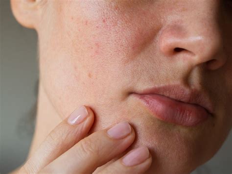 Acne On Cheeks 2023 Why Youre Breaking Out And How To Treat It Ph