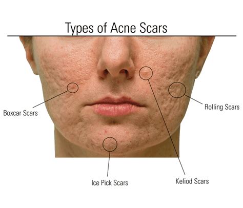 From Ice Pick Scars To Hyperpigmentation Treat Acne Scars Naturally