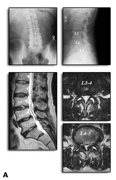 Section 2 Chapter 11 In Vivo Biomechanical Assessment Of The Lumbar
