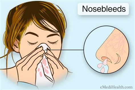 How To Stop A Nosebleed Treatment And Home Remedies