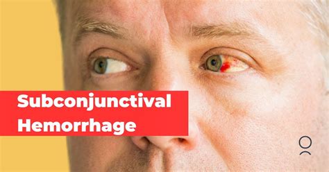 Subconjunctival Hemorrhages Causes Symptoms And Treatment