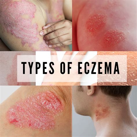 Get 22 Eczema Types Of Skin Diseases