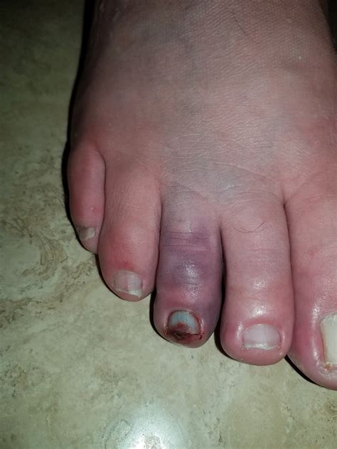 Broken Toe A Month Later The Hull Truth Boating And Fishing Forum