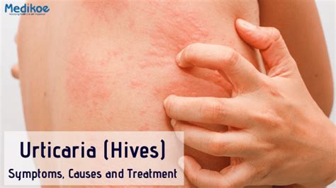 Urticaria Hives Symptoms Causes And Treatment Medikoe