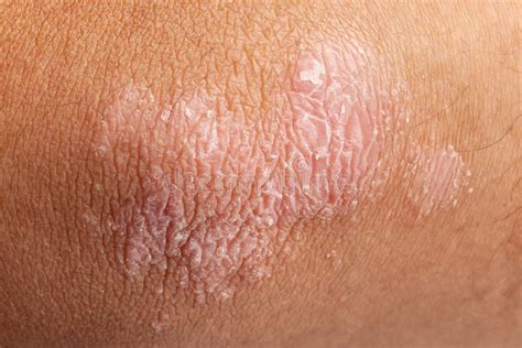 Psoriasis On Elbow Skin Stock Photo Image 40723075