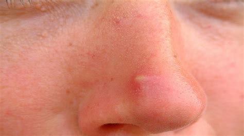 Pimple On Face Can Be A Sign Of Skin Cancer Reveals Study
