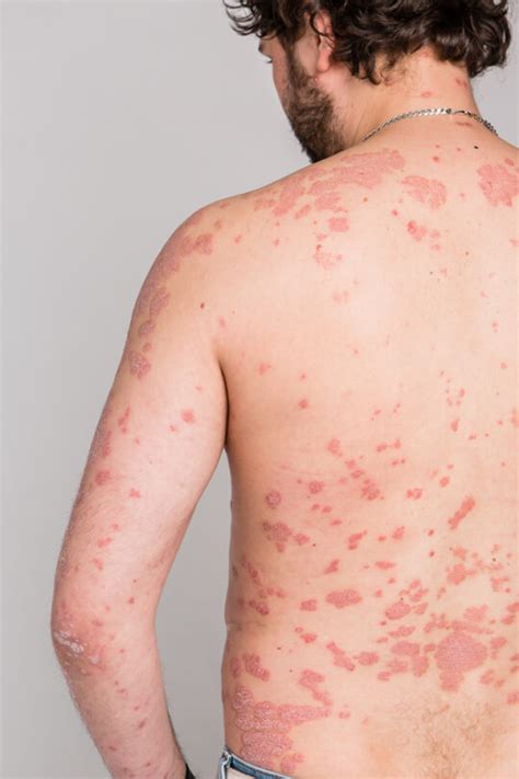 Psoriasis Schuppenflechte Hautarztpraxis Rgs