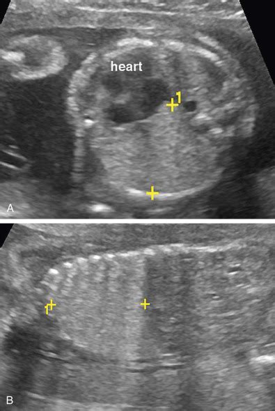 Ultrasound Evaluation Of The Fetal Thorax Obgyn Key