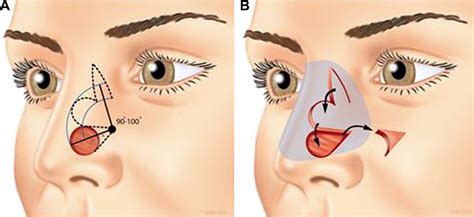 Transposition Flaps In Nasal Reconstruction Facial Plastic Surgery