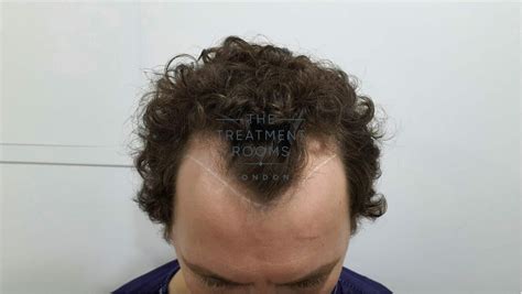 Fixing A Widows Peak With A Hair Transplant Treatment Rooms London