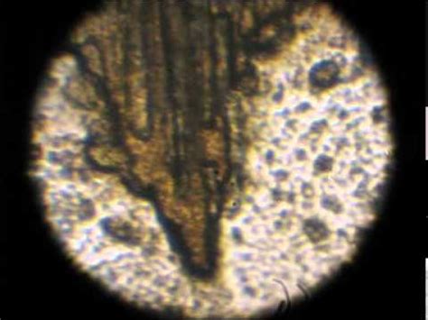 Morgellons treatment, morgellons disease, shingle, lyme disease, fibromyalgia, dermatitis, eczema is morgellons disease & morgellons is a fungi. Morgellons-Demodex-Parasites: my struggle with them - 1 ...