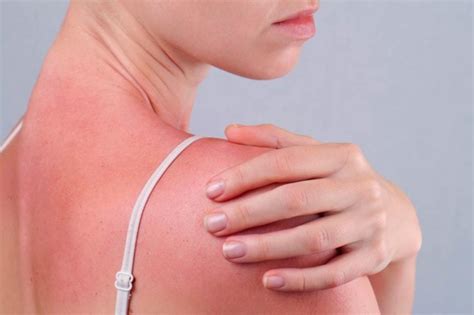 Sun Poisoning Symptoms And Signs Sunburn Chills And Sick The Healthy