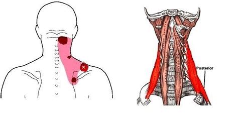 The Posterior Neck Muscle Location And Trigger Points Trigger Points Muscle Knots Knots In