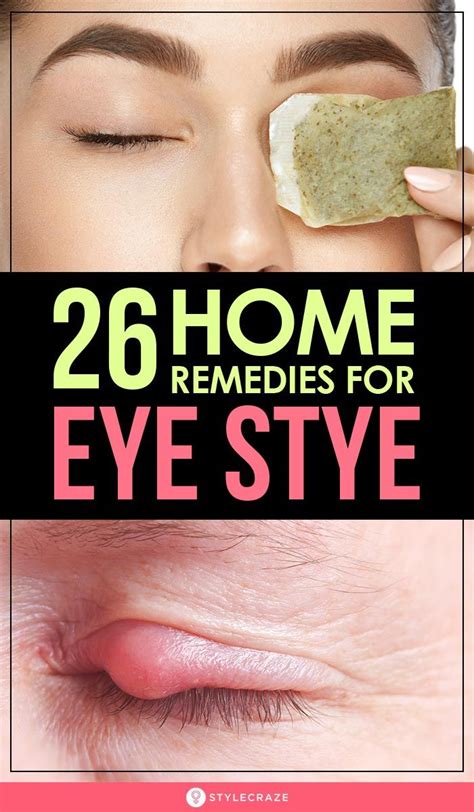 26 Effective Home Remedies For Eye Stye Sty In Eye Remedies Swollen