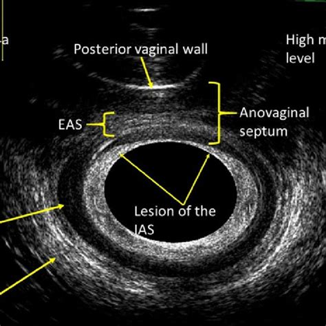 Pdf Endoanal Ultrasound For Anorectal Diseases