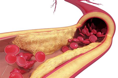 Atherosclerosis Specialists Naples Cardiac And Endovascular Center