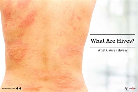What Are Hives What Causes Hives By Dr Deepshikha Parihar Lybrate