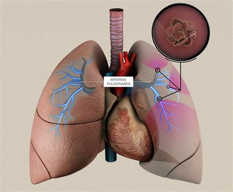 Toda la información sobre la embolia pulmonar TROMBO info