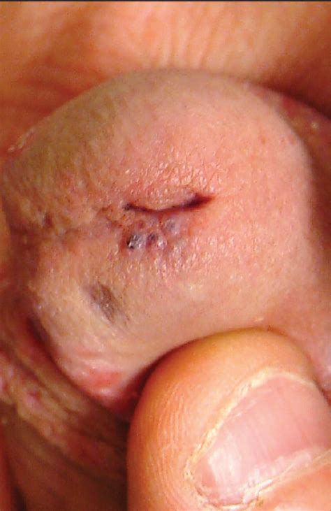 Noninfectious Penile Lesions Clinician Reviews