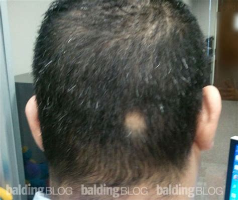 Bald Spot On My Head Onettechnologiesindiacom