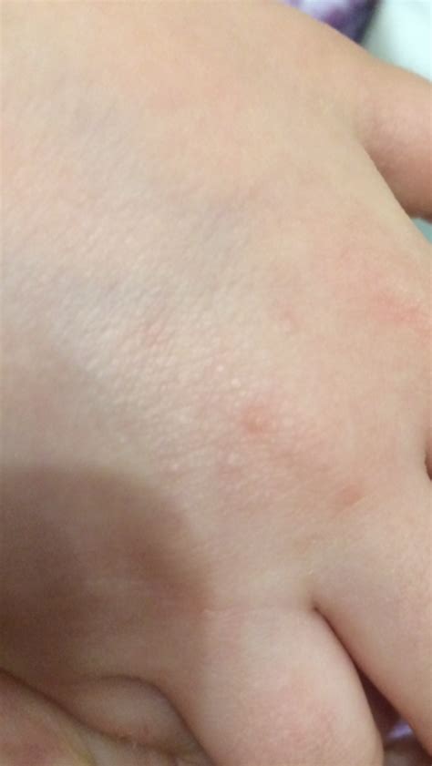 Аллергия у ребенка на руках появляется весной Вопрос аллергологу 03