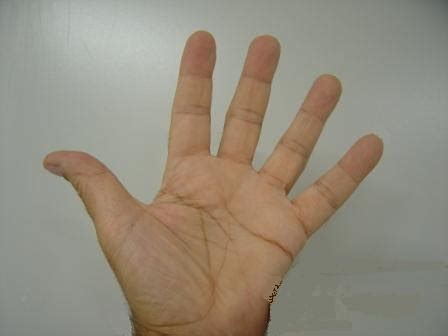 Panjang jari perbandingan panjang jari dapat memberitahu kemungkinan penyakit tertentu. Petua,Idea dan Pandangan: Rahsia Tanda -Tanda Penyakit ...