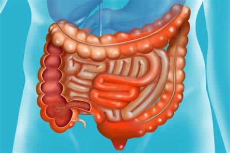 New Index Developed For Assessment Of Perianal Fistulas In Crohn Disease Gastroenterology Advisor