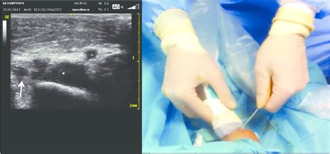 Cubital Tunnel Ultrasound In A Beyond 90º Lexed Elbow Showing The
