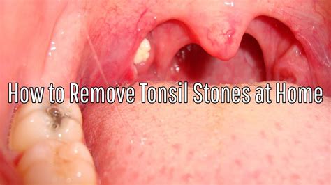 How To Remove Tonsil Stones At Home Youtube