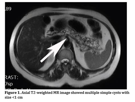 Persistently Recurrent Epigastric Distress