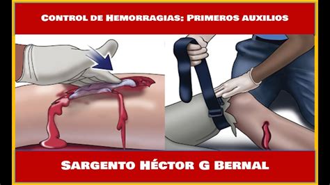 Control De Hemorragias PRIMEROS AUXILIOS YouTube