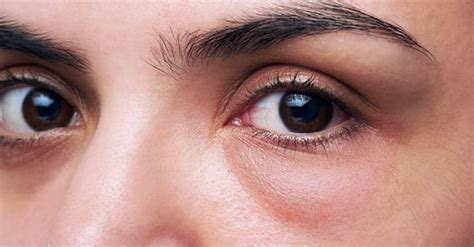 Eye Bags Types Causes And Treatment Premier Clinic