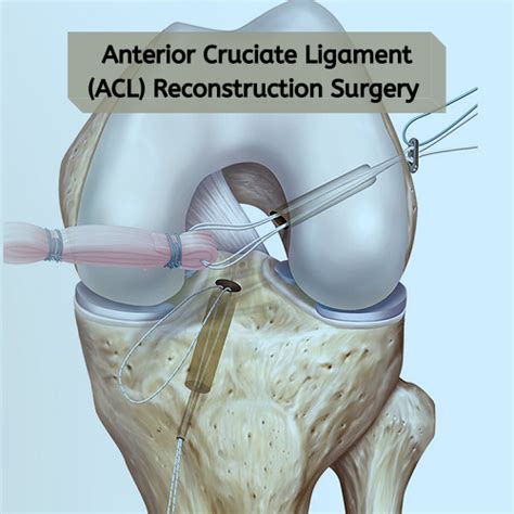 Anterior Cruciate Ligament Acl Reconstruction Surgery Knee