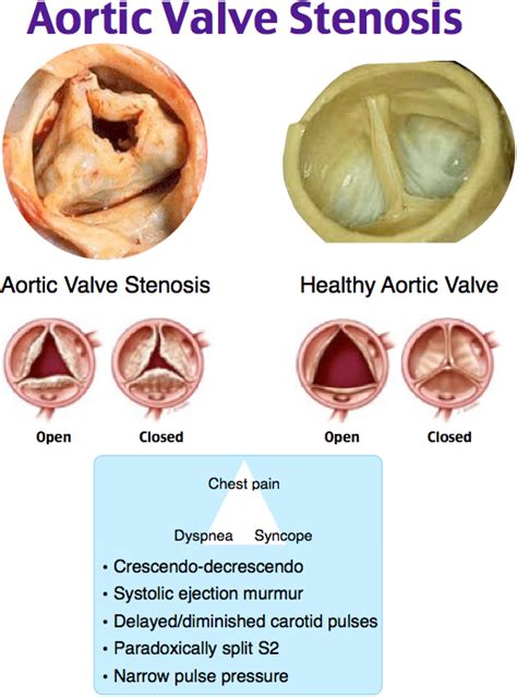 Pathophysiology Of Aortic Valve Stenosis Is It Both Fibrocalcific And